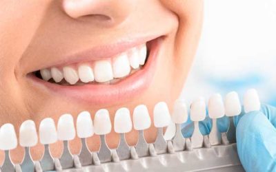 ¿Cómo influye en mi estética que me ponga carillas hechas de un material u otro?