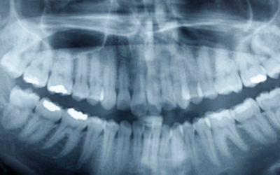 ¿Puedo ponerme un implante con poco hueso?