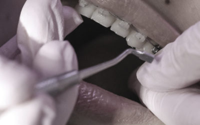 ¿Cuántos tipos de ortodoncia existen? Ortodoncia a todas las edades