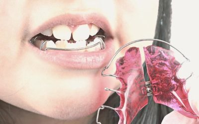 ¿Qué es y para qué sirve la ortodoncia interceptiva?