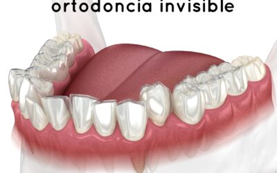 3 ventajas de la ortodoncia invisible