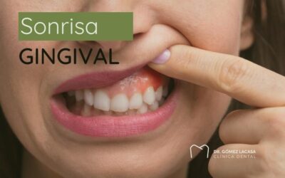 La sonrisa gingival