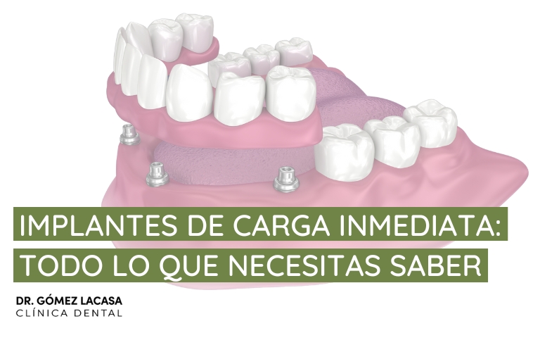Implantes de carga inmediata: todo lo que necesitas saber