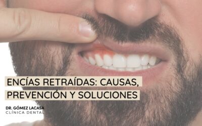 Encías retraídas: causas, prevención y soluciones