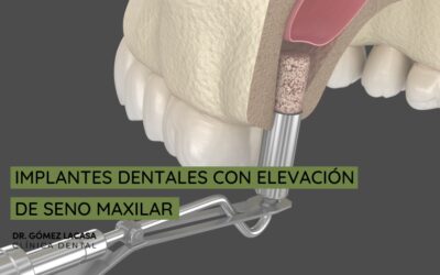 Implantes dentales con elevación de seno maxilar