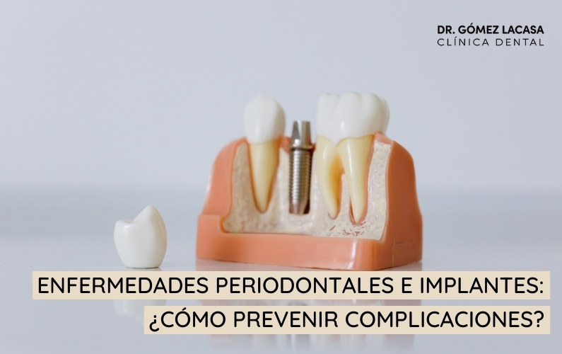 Enfermedades periodontales e implantes: ¿Cómo prevenir complicaciones?