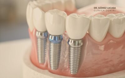 Cirugía guiada: Precisión y seguridad en implantología moderna